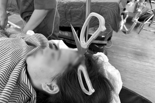 Cấp cứu kịp thời cô gái trẻ 25 tuổi bị kéo đâm xuyên não nguy hiểm