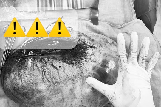 Bé gái 13 tuổi bụng to lên bất thường với khối u buồng trứng khổng lồ gần 8 kg