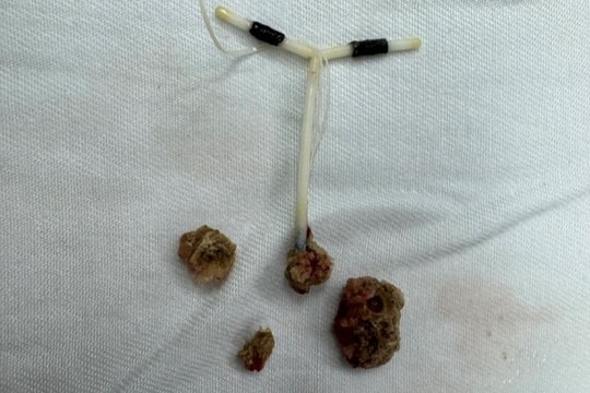 Đặt vòng 10 năm, phát hiện dị vật tạo sỏi lớn trong bàng quang