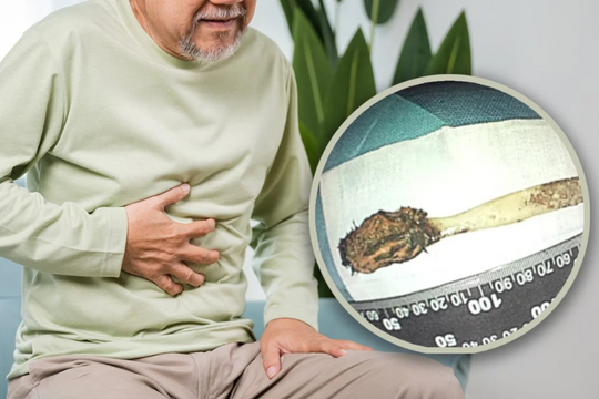 Bàn chải đánh răng mắc kẹt trong ruột người đàn ông hơn 50 năm