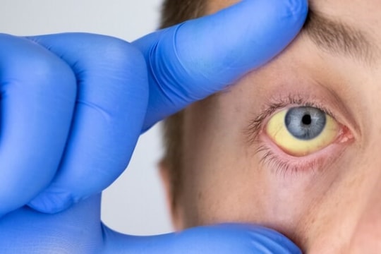 Sốt vàng: Bệnh nguy hiểm do virus, lây qua muỗi vằn