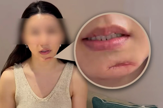 Biến chứng nặng sau phẫu thuật thẩm mỹ vì tin quảng cáo