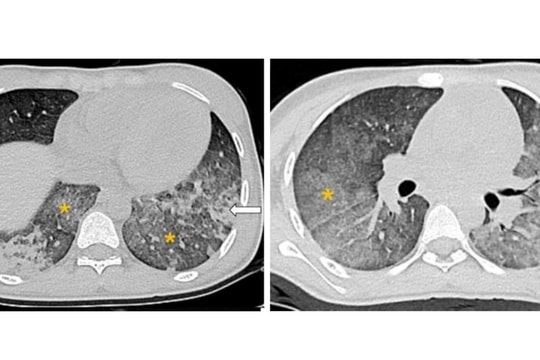Bé gái 14 tuổi suýt nguy kịch vì biến chứng chảy máu phế nang lan tỏa