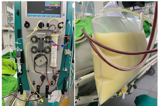 Không béo phì vẫn có chỉ số mỡ máu cao gấp 37 lần thông thường