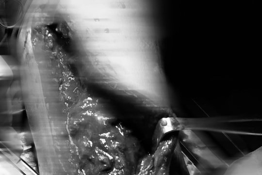 Hoại tử cánh tay khi tự tiêm mật gấu tại nhà