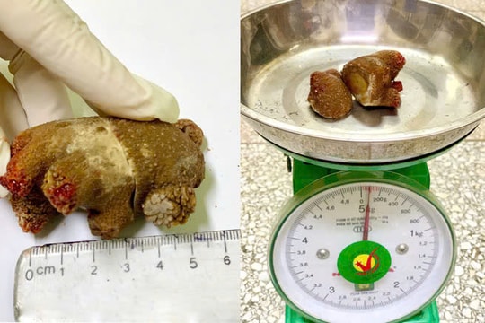 Viên sỏi “khổng lồ” như san hô trong thận bệnh nhân suốt 20 năm