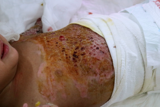 Cứu sống bé 2 tuổi bị phỏng 60% nhờ ghép da đồng loại từ mẹ ruột