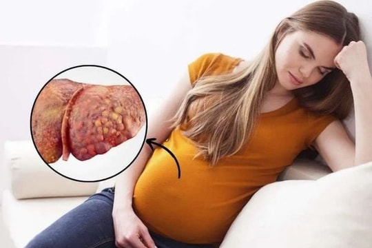 Cứu sống sản phụ mắc bệnh hiếm cực nguy hiểm