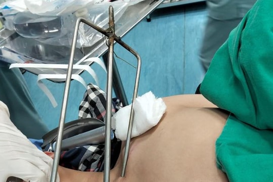 Cứu sống bệnh nhân bị xiên vịt nướng đâm xuyên cổ