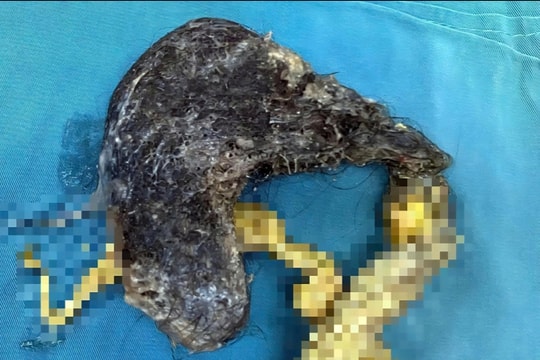 Bé 5 tuổi nhập viện vì ăn tóc, hội chứng lạ gây tắc ruột, thủng dạ dày