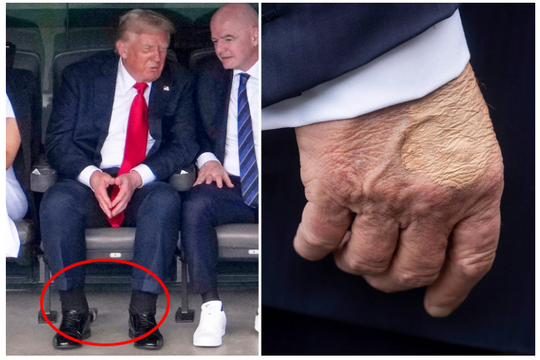 Tổng thống Trump bị suy tĩnh mạch: Những điều cần biết về căn bệnh thường gặp ở người cao tuổi