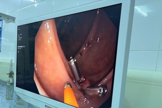 Bệnh viện Cẩm Phả cấp cứu thành công ca xuất huyết nguy kịch giữa lúc ứng trực bão số 3