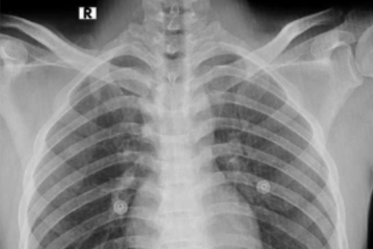 Cấp cứu nam thanh niên 26 tuổi nuốt dao rọc giấy và dao lam