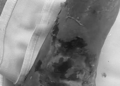 Người đàn ông nhiễm trùng nặng vì tự ý đắp thuốc sau khi bị rắn cắn