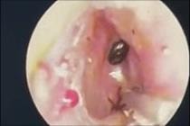 Phát hiện nhiều dị vật bọ chét chó trong 2 tai của bệnh nhi 9 tuổi