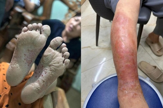 Bác sĩ cảnh báo bệnh da liễu sau mưa lũ: Vết ngứa nhỏ có thể thành ổ nhiễm trùng