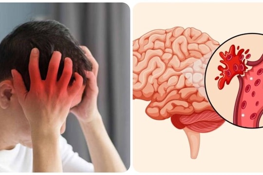 Can thiệp “giờ vàng”: Chìa khóa cấp cứu bệnh nhân đột quỵ