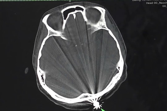 Phẫu thuật thành công cho phụ nữ bị viên đạn lạc găm vào đầu khi đang làm vườn