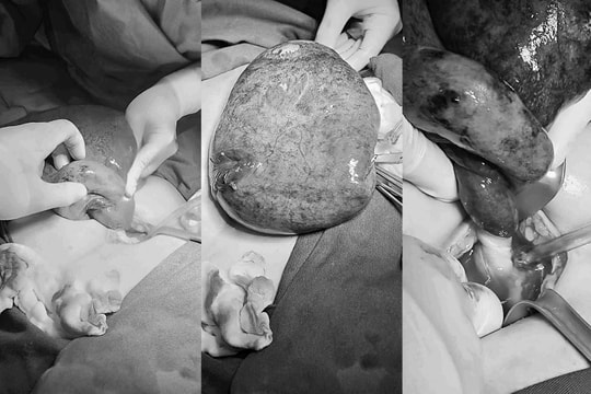 Bé gái 15 tuổi mang khối nang "khổng lồ" tương đương thai 7 tháng