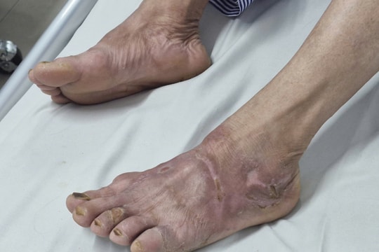 Tưởng viêm da, 2 cha con cùng mắc bệnh… phong