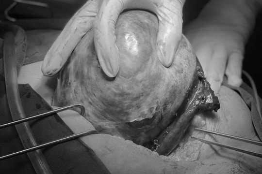 Đau bụng kéo dài, phát hiện u buồng trứng xoắn hoại tử nặng 5kg