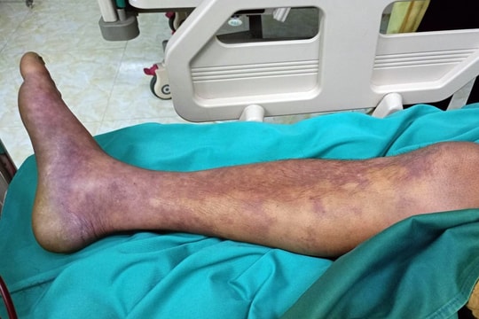 Hà Nội ghi nhận 1 ca tử vong vì mắc liên cầu lợn