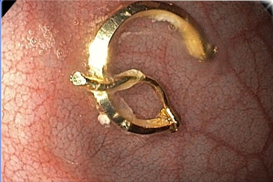 Khuyên tai “đi lạc” trong dạ dày bé gái 8 tháng tuổi