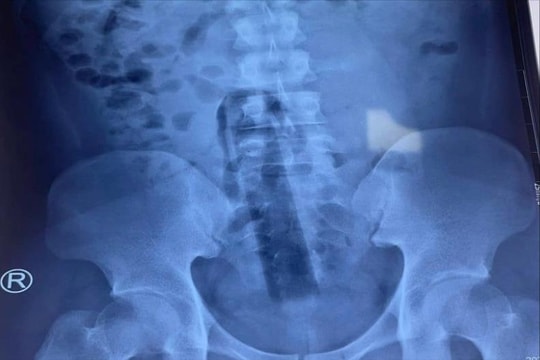 Dị vật cán cây lau nhà 15cm mắc kẹt trong hậu môn của nam thanh niên