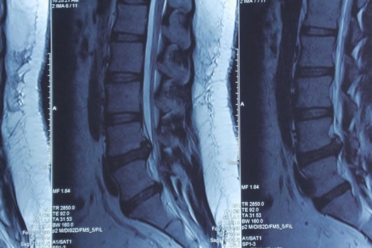 Cô gái 23 tuổi suýt liệt chân vì thoát vị đĩa đệm