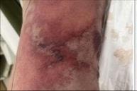 Người đàn ông suýt mất mạng vì vết thương nhỏ khi đi biển