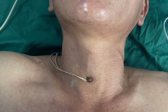 Cứu sống bệnh nhân bị đinh thép xuyên khí quản