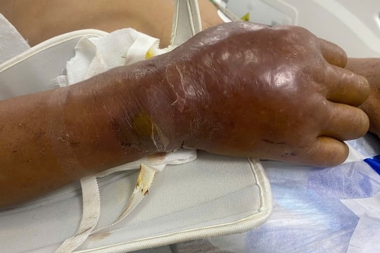 Chủ quan với vết thương ở tay, người đàn ông ngưng thở tím tái do uốn ván