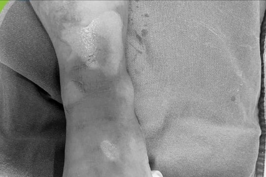 Bác sĩ khuyến cáo: Cẩn trọng tai nạn bỏng nước sôi ở trẻ nhỏ