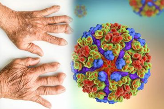 Những điều cần biết về virus chikungunya giữa lúc dịch lan rộng tại Trung Quốc