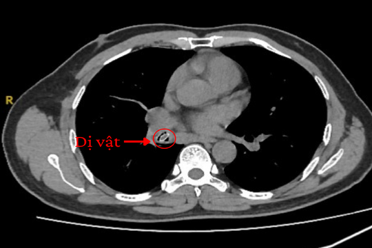 Bác sĩ khuyến cáo: Ho dai dẳng suốt một năm trời do hóc dị vật