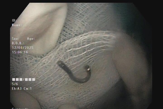 Bé trai 5 tuổi thoát nguy hiểm sau khi nuốt móc cài vòng bạc