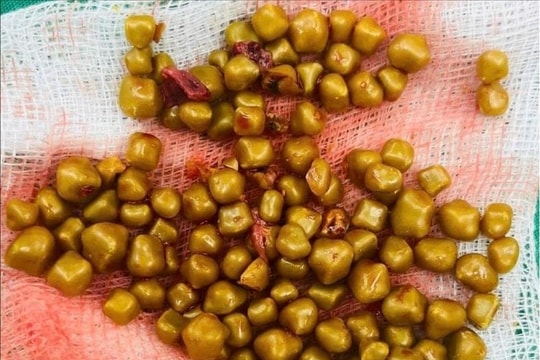 Mổ cấp cứu nữ bệnh nhân có hơn 100 viên sỏi chứa đầy trong túi mật