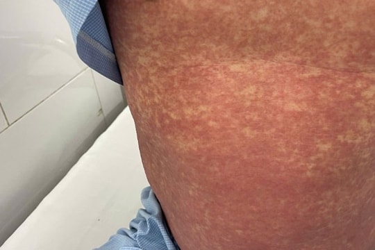 Bộ Y tế cảnh báo không mua, bán hoặc sử dụng thuốc chứa Phenylbutazone