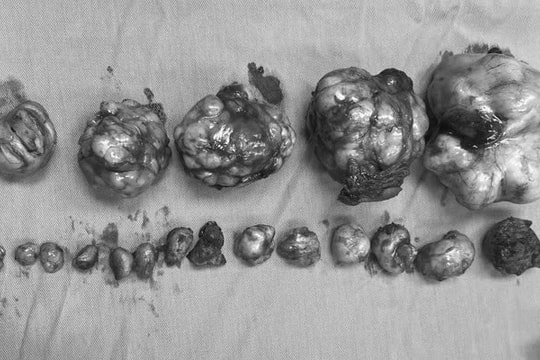 Hiếm gặp: Bóc tách 19 khối u xơ tử cung cho nữ bệnh nhân 32 tuổi