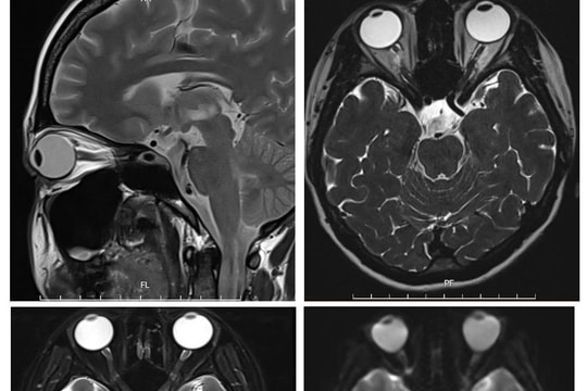“Giải thoát” nữ bệnh nhân khỏi bệnh rối loạn phổ viêm tủy thị thần kinh thể hiếm gặp