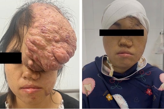 Khối u khổng lồ khiến khuôn mặt cô gái biến dạng suốt 15 năm