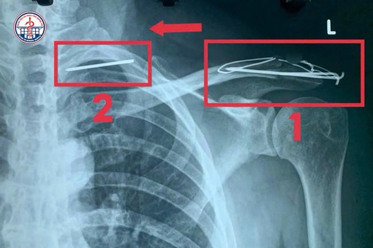 Hi hữu: Đinh phẫu thuật 'lang thang' trong lồng ngực bệnh nhân