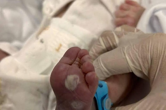 Trẻ sơ sinh mắc giang mai bẩm sinh: Hồi chuông cảnh báo tầm soát thai kỳ