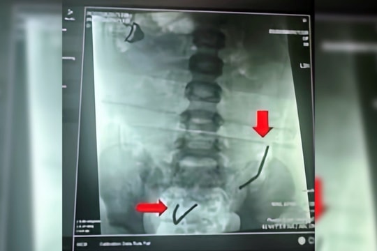 Bé trai thủng ruột do nuốt hơn 20 viên nam châm xếp hình