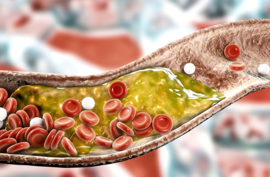 Vì sao ăn chay nhưng vẫn bị tăng mỡ máu ?