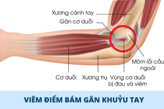 Không chỉ dân thể thao, ai cũng dễ mắc viêm gân khuỷu tay