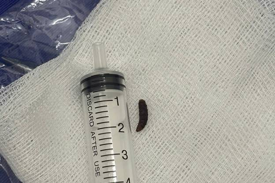 Bé 14 tháng tuổi quấy khóc dữ dội, bác sĩ phát hiện dòi sống trong tai