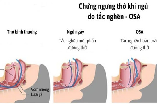 Ngáy to, buồn ngủ ban ngày: Dấu hiệu của hội chứng nguy hiểm OSA