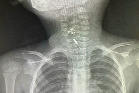 Bé 5 tuổi ở Phú Thọ phải đi cấp cứu vì nuốt kẹp tóc