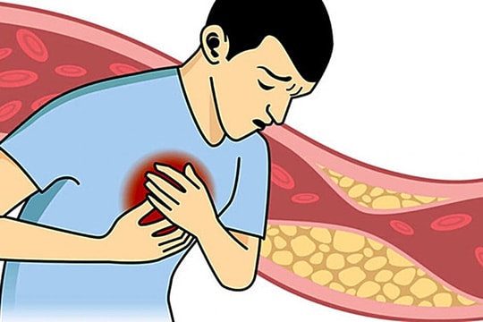 Nam bệnh nhân trẻ nhập viện vì bị nhồi máu cơ tim, nguyên nhân từ đâu?